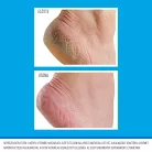 O’Keeffe’s Healthy Feet hidratáló lábmaszk használata előtt és után – repedezett sarok regenerálódására