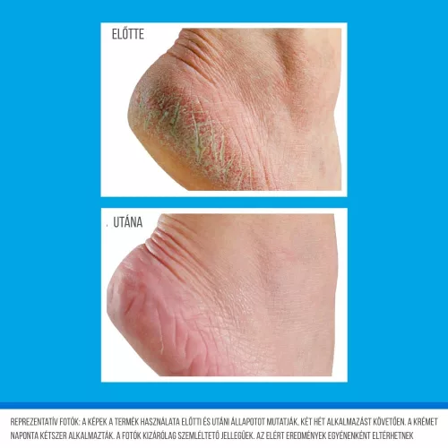 O’Keeffe’s Healthy Feet hidratáló lábmaszk használata előtt és után – repedezett sarok regenerálódására