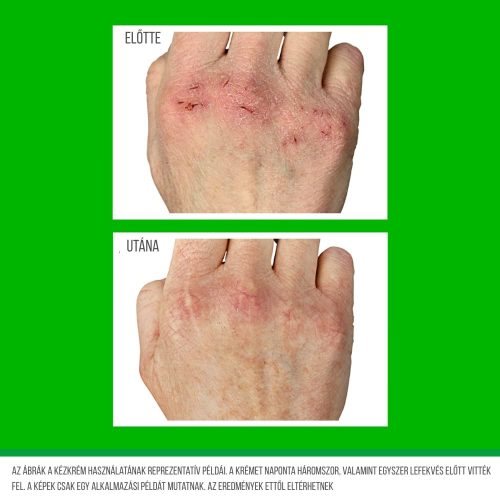 O’Keeffe’s Working Hands kézkrém használata előtte és utána – repedezett kézbőr javulása